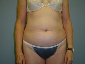 liposuction patient