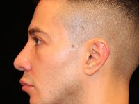 male blepharoplasty patient