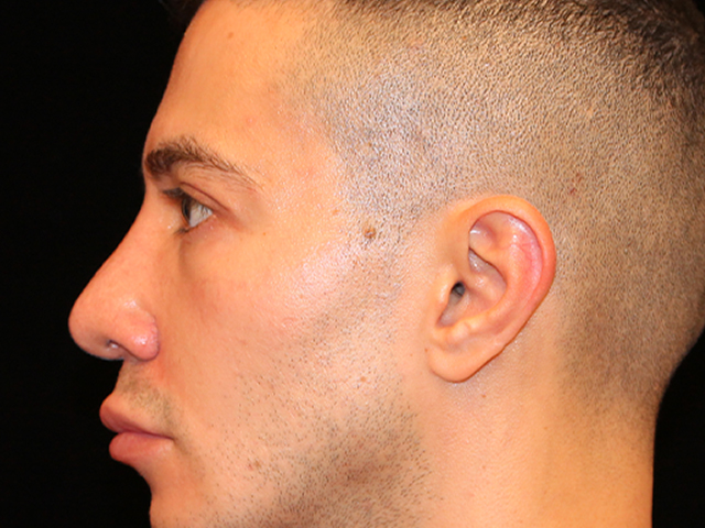male blepharoplasty patient