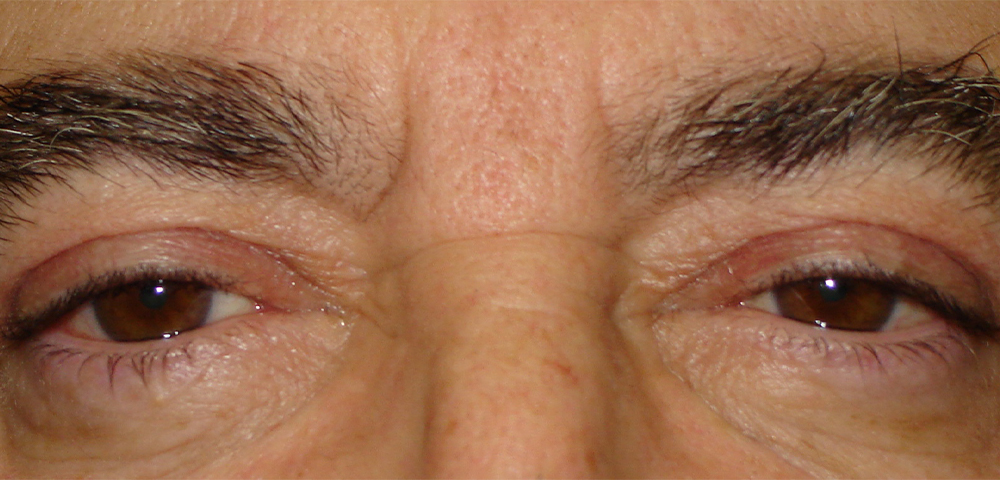 male blepharoplasty patient