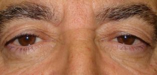 male blepharoplasty patient