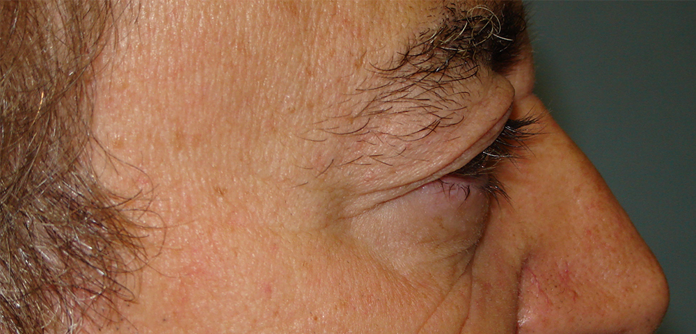 male blepharoplasty patient