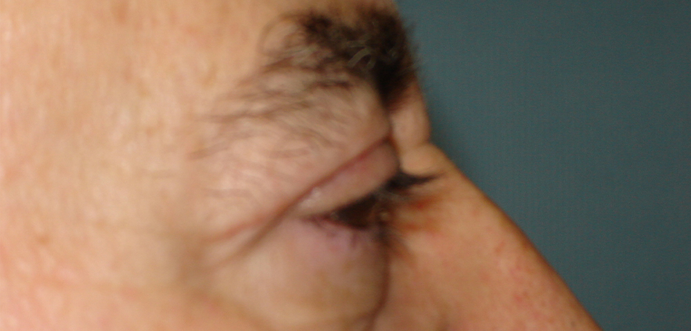 male blepharoplasty patient