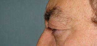 male blepharoplasty patient