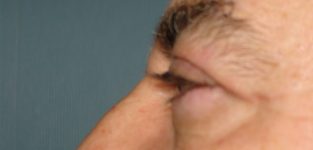 male blepharoplasty patient