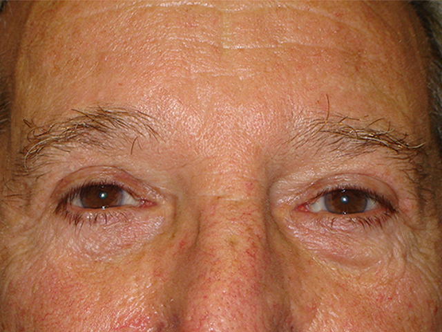 male blepharoplasty patient