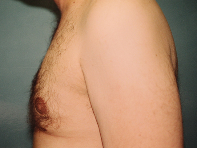 male breast reduction patient