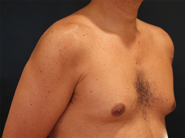 male breast reduction patient