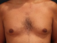 male breast reduction patient