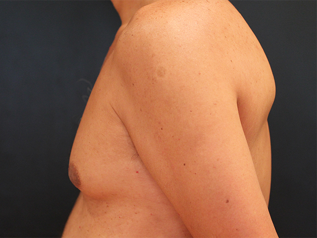 male breast reduction patient