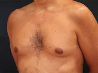 male breast reduction patient