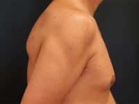 male breast reduction patient