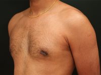 male breast reduction patient