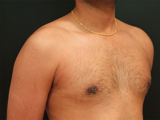 male breast reduction patient