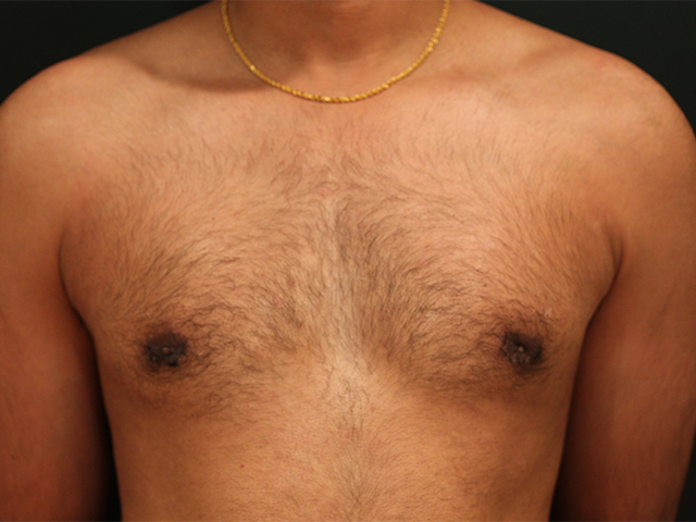 male breast reduction patient