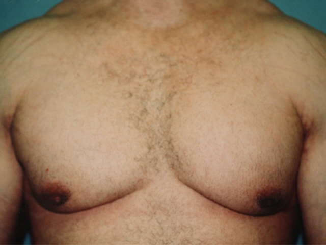 male breast reduction patient