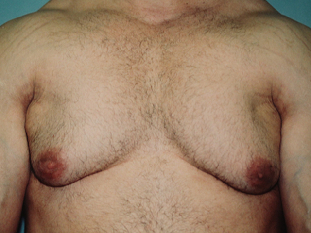 male breast reduction patient