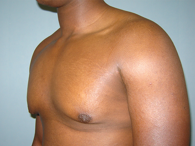 male breast reduction patient