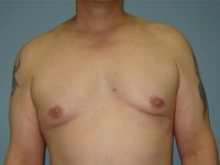 male breast reduction patient