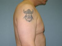 male breast reduction patient