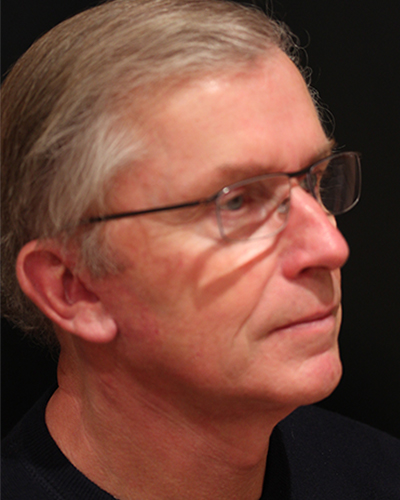 male facelift patient