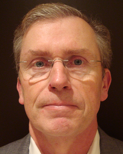 male facelift patient