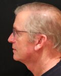 male facelift patient
