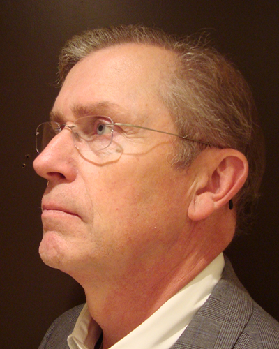 male facelift patient