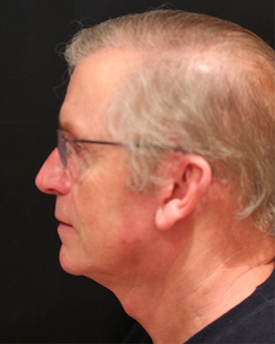 male facelift patient