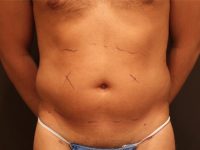 male liposuction patient