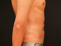 male liposuction patient