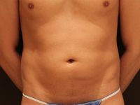 male liposuction patient