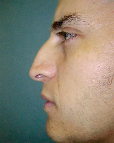 male rhinoplasty patient