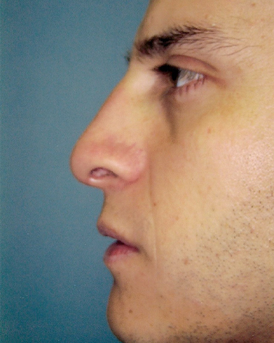 male rhinoplasty patient