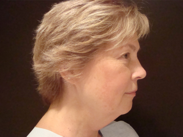 neck liposuction patient