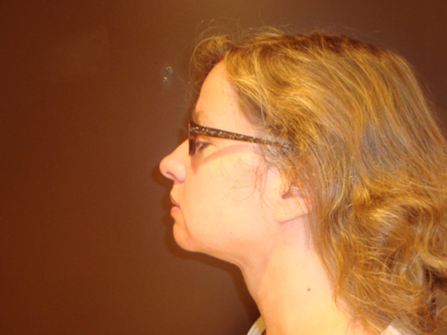 neck liposuction patient