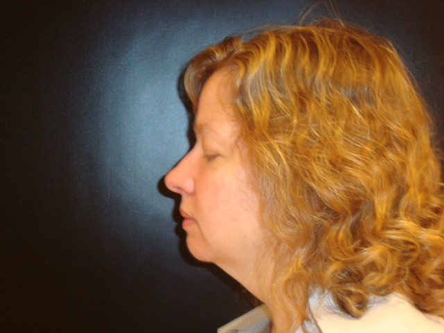 neck liposuction patient