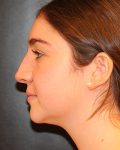 rhinoplasty patient