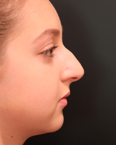 rhinoplasty patient
