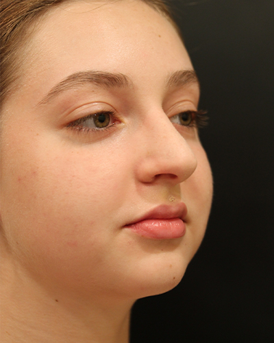 rhinoplasty patient