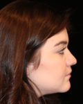 rhinoplasty patient