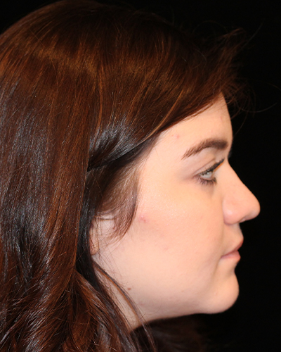 rhinoplasty patient
