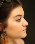 rhinoplasty patient