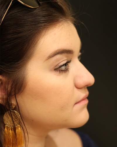 rhinoplasty patient