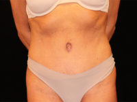 tummy tuck patient
