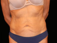 tummy tuck patient