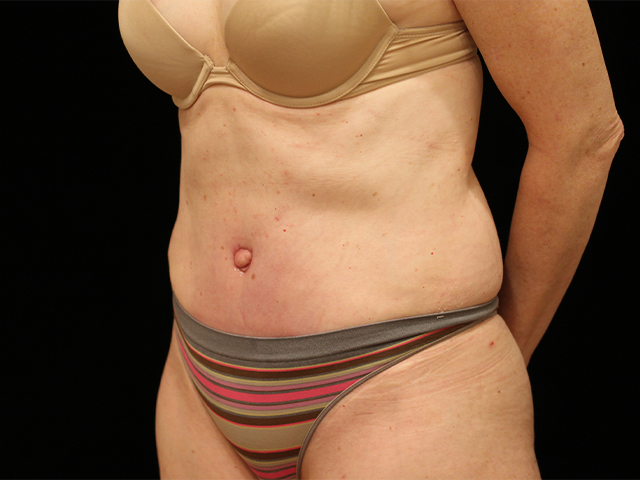 tummy tuck patient