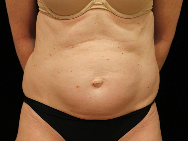 tummy tuck patient