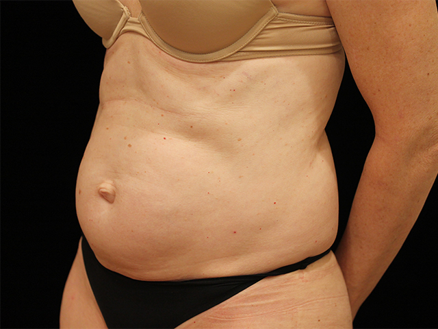 tummy tuck patient