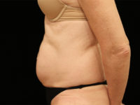 tummy tuck patient